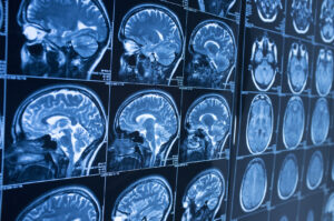 Why Choose Heaton McLean Personal Injury Lawyers for Help After a Brain Injury in Austin, TX?